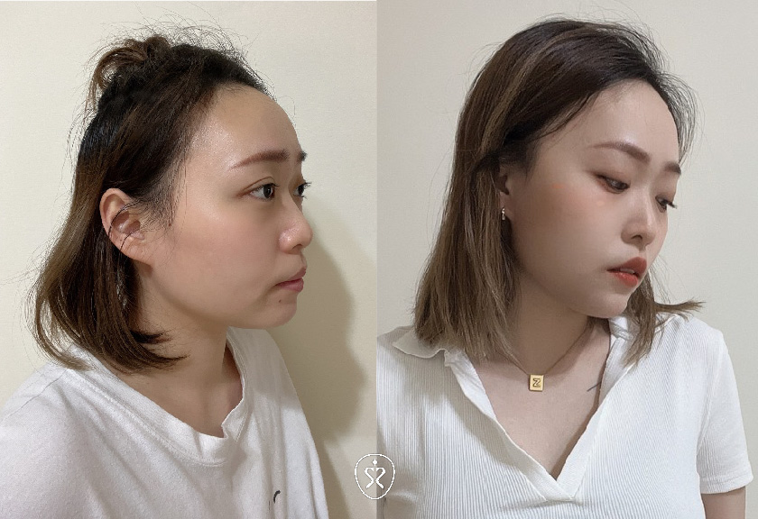 【玻尿酸下巴+肉毒瘦小臉】